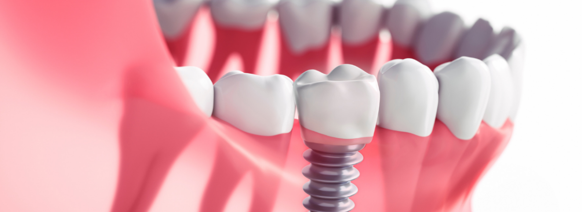 Dental Implants In Leicester