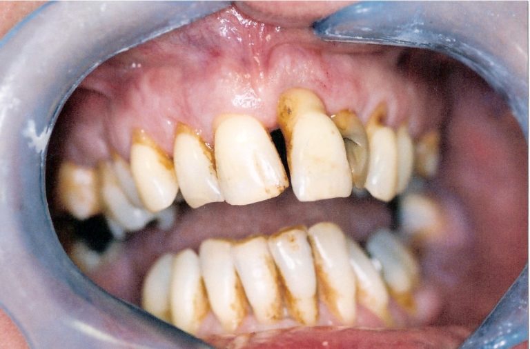 Bridgework-at-Care-Dental-Leicester-Case-1-768x506