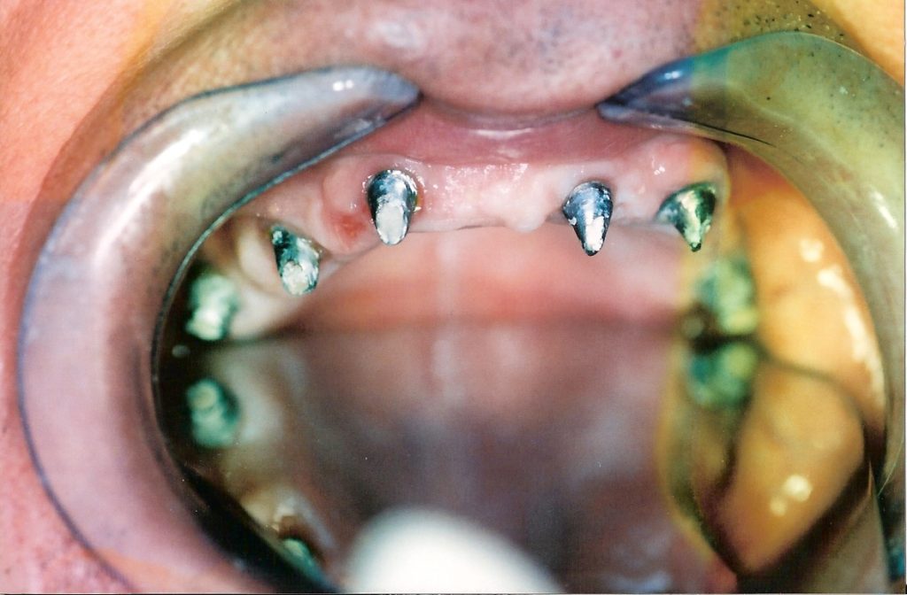 Dental-Implants-at-Care-Dental-Leicester-Case-1-1024x672