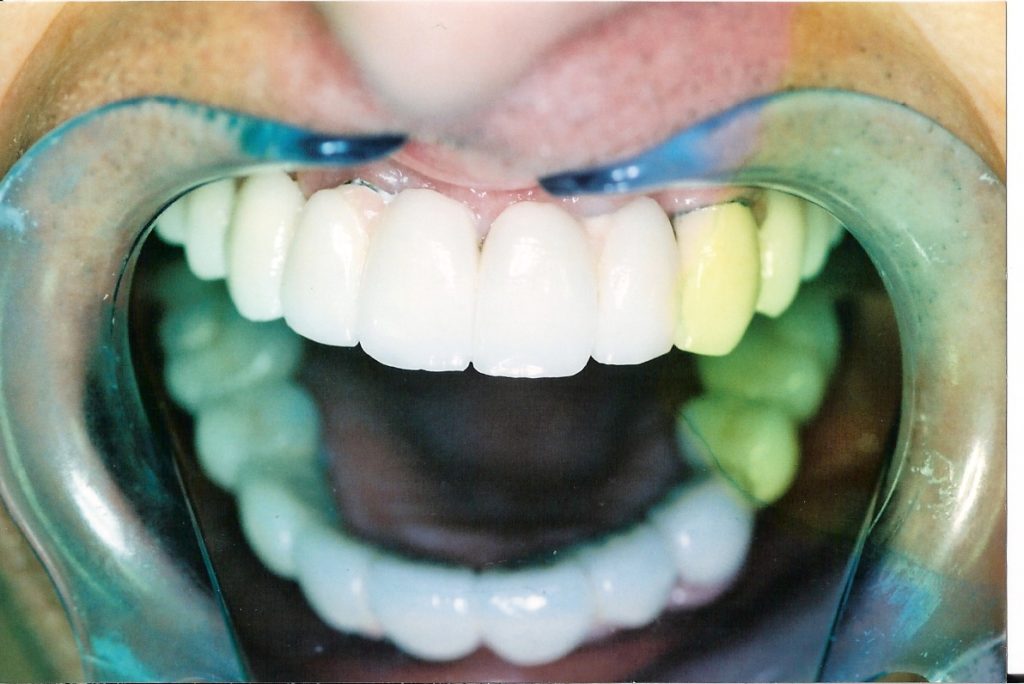 Dental-Implants-at-Care-Dental-Leicester-Case-1.1-1024x684