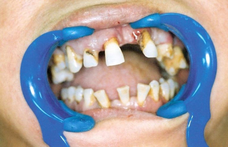 Dental-Implants-at-Care-Dental-Leicester-Case-2-768x494
