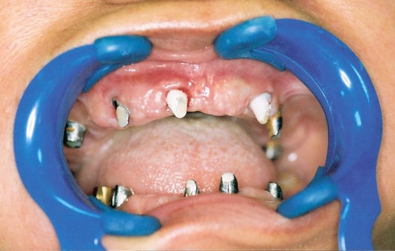 Dental-Implants-at-Care-Dental-Leicester-Case-2.2-768x488