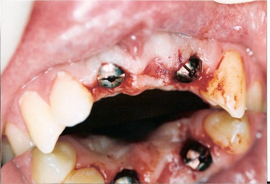 Dental-Implants-at-Care-Dental-Leicester-Case-4-1024x698