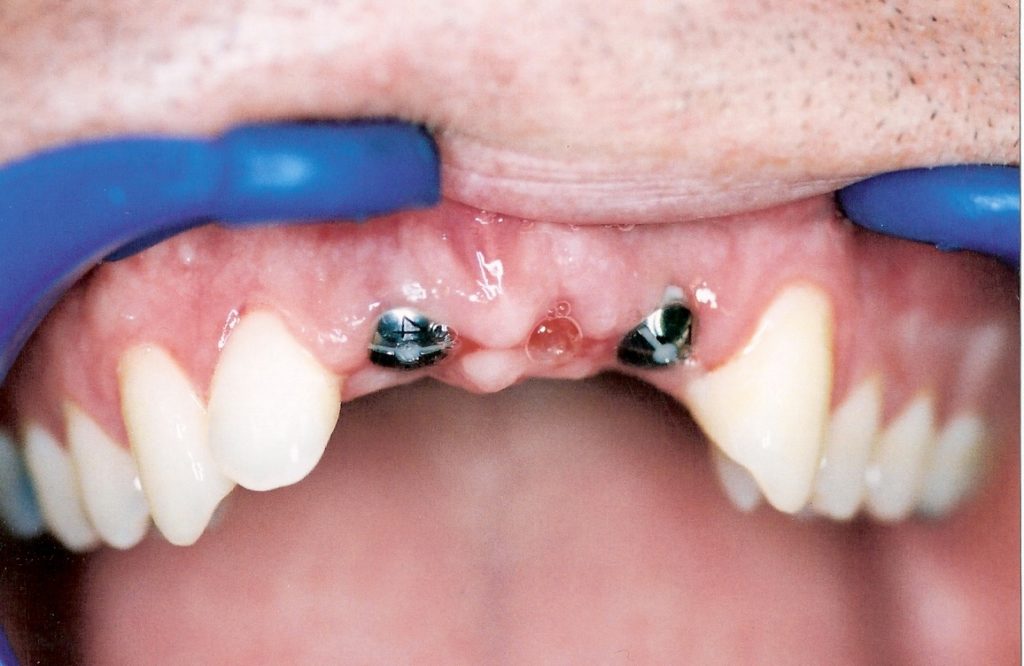 Dental-Implants-at-Care-Dental-Leicester-Case-4.1-1024x666