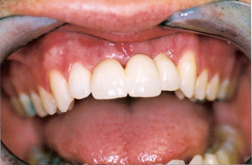 Dental-Implants-at-Care-Dental-Leicester-Case-4.3-1024x672