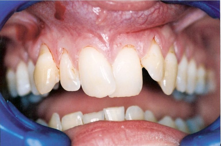 Dental-Veneers-at-Care-Dental-Leicester-Case-1-768x510