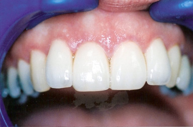 Dental-Veneers-at-Care-Dental-Leicester-Case-1.1-768x508
