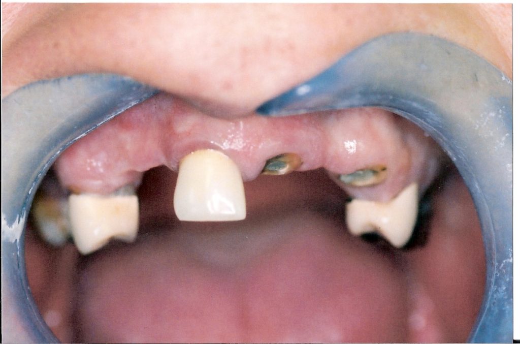 Full-Arch-Bridgework-at-Care-Dental-Leicester-Case-1.1-1024x677