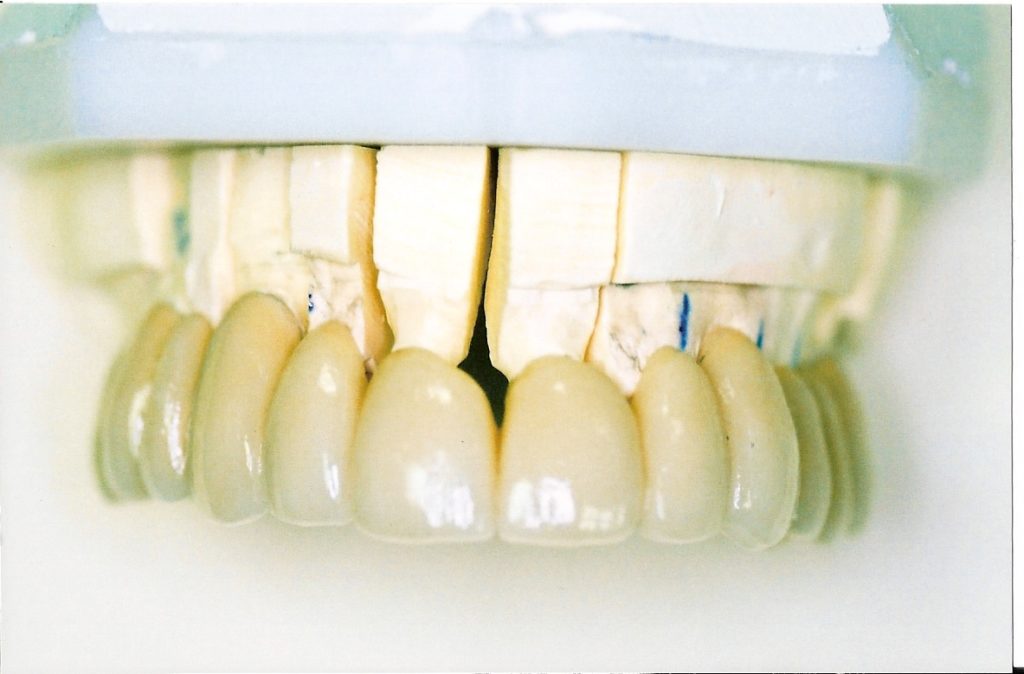 Full-Arch-Bridgework-at-Care-Dental-Leicester-Case-1.2-1024x674