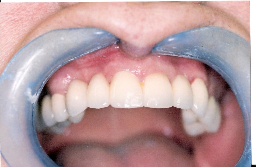 Full-Arch-Bridgework-at-Care-Dental-Leicester-Case-1.4-1024x669