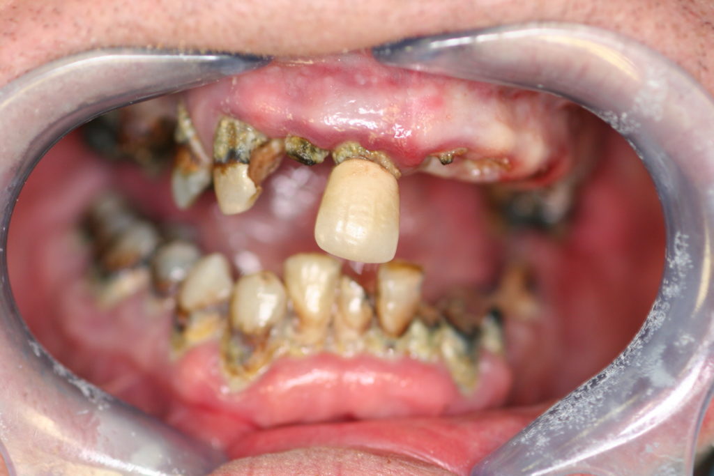 Full-Mouth-Rehabilitation-at-Care-Dental-Leicester-Case-1-1024x683