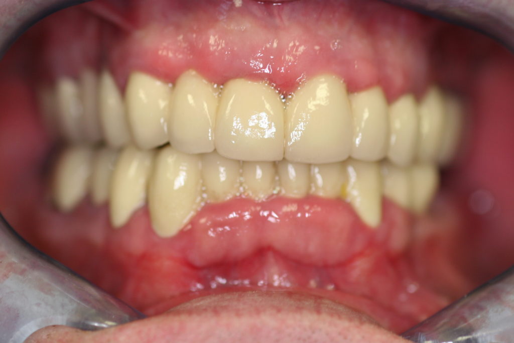 Full-Mouth-Rehabilitation-at-Care-Dental-Leicester-Case-1.1-1024x683