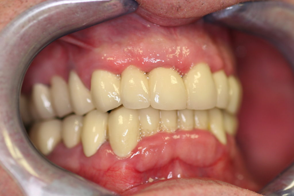 Full-Mouth-Rehabilitation-at-Care-Dental-Leicester-Case-1.2-1024x683