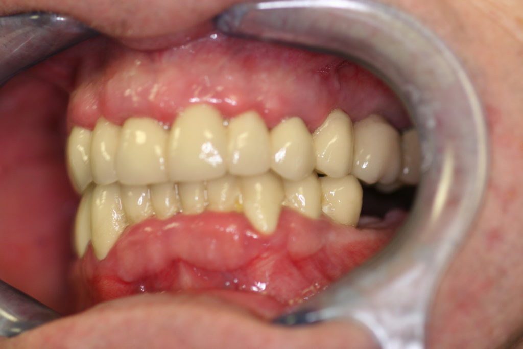 Full-Mouth-Rehabilitation-at-Care-Dental-Leicester-Case-1.3-1024x683