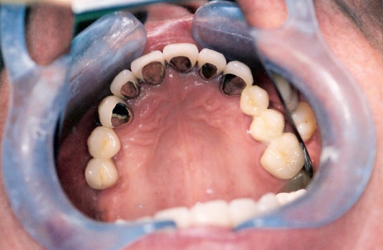 Full-Mouth-Rehabilitation-at-Care-Dental-Leicester-Case-3.1-1-768x503
