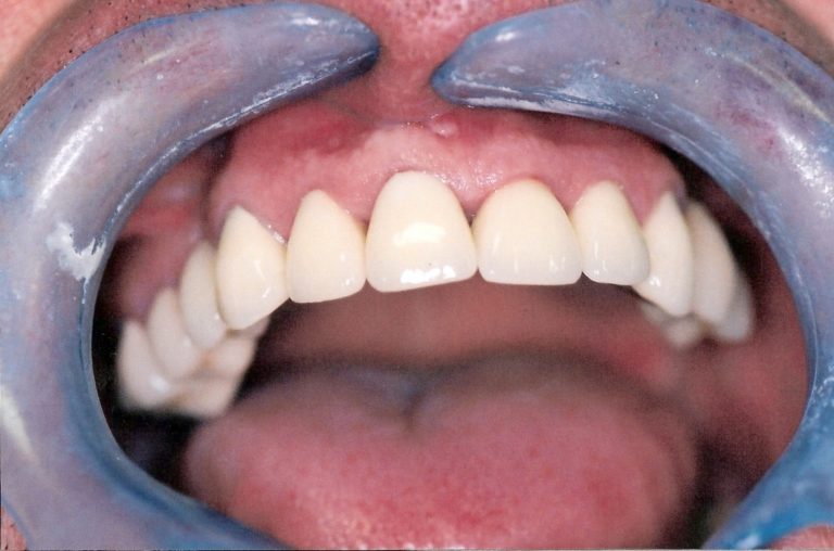 Full-Mouth-Rehabilitation-at-Care-Dental-Leicester-Case-3.2-1-768x508