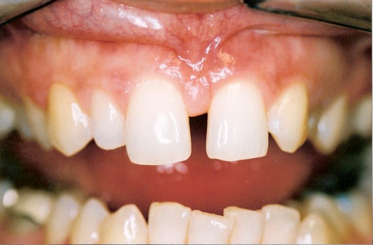 Porcelain-Veneers-at-Care-Dental-Leicester-Case-2-768x504
