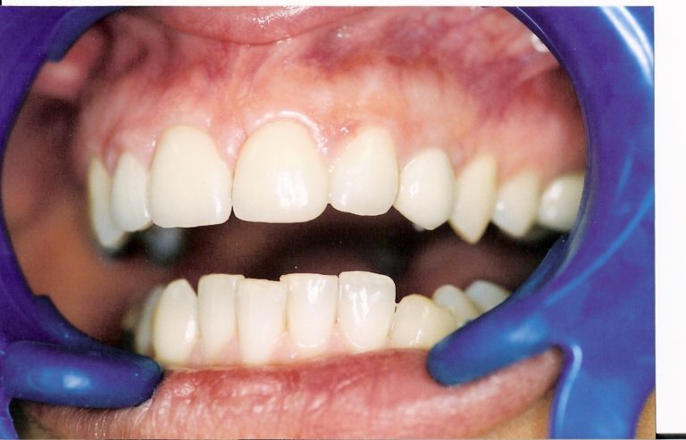 Porcelain-Veneers-at-Care-Dental-Leicester-Case-2.3-768x493
