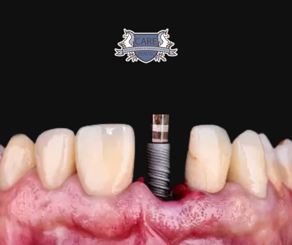 dental implants in leicester // type of implant // single implant