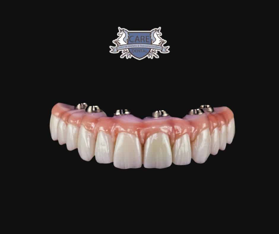 dental implants in leicester // type of implant // All On 4 Dental Implants