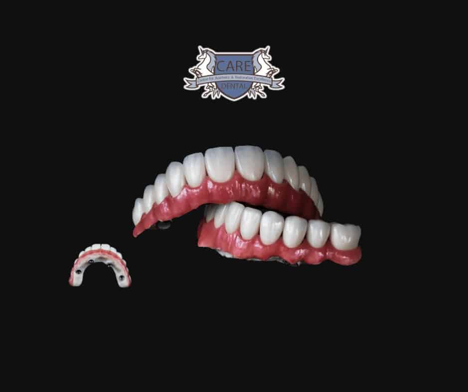 dental implants in leicester // type of implant // All On 6 Dental Implants