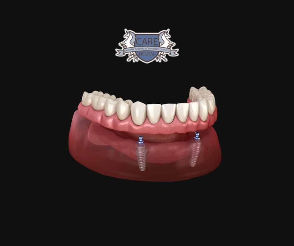 dental implants in leicester // type of implant // Implant Retained Denture Bridge